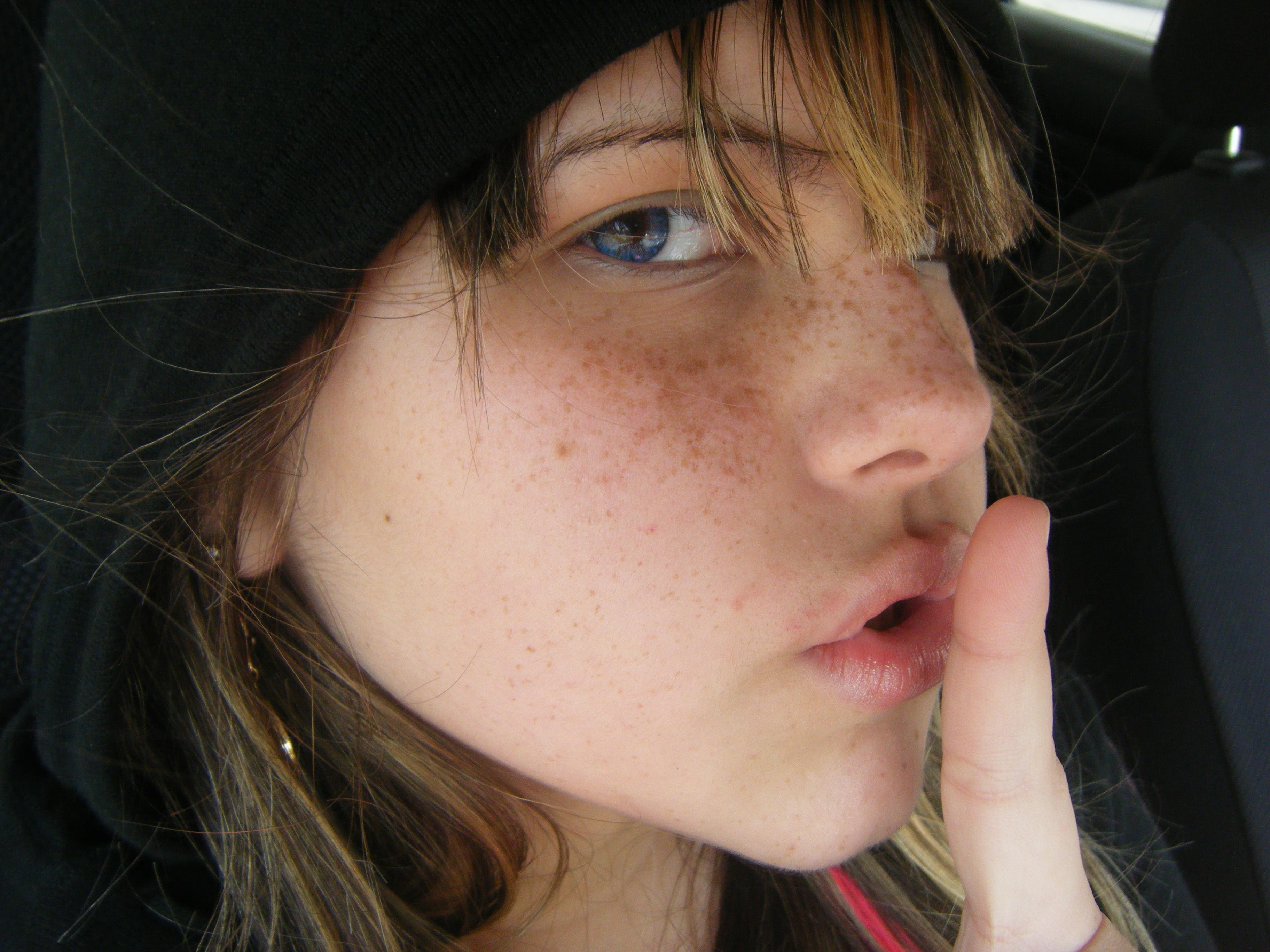 Teen Freckles